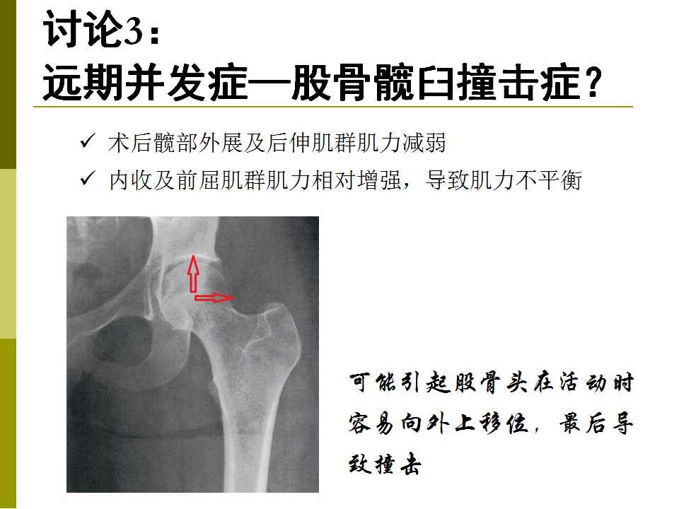 关节镜松解治疗注射性臀肌挛缩症7年705例1408臀报道