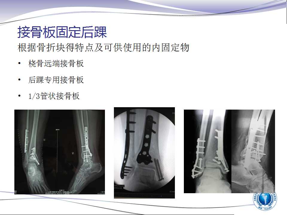 踝关节后外侧及外侧入路