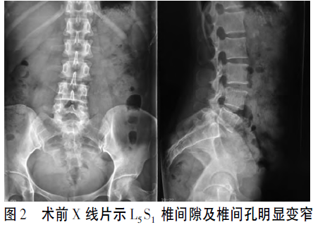 单侧椎弓根螺钉固定联合椎间融合术治疗腰椎间盘突出症