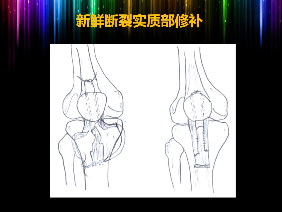髌腱断裂