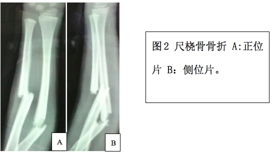 所以骨折线位置低.桡骨为横型或锯齿状,尺骨为短斜型,骨折移位.