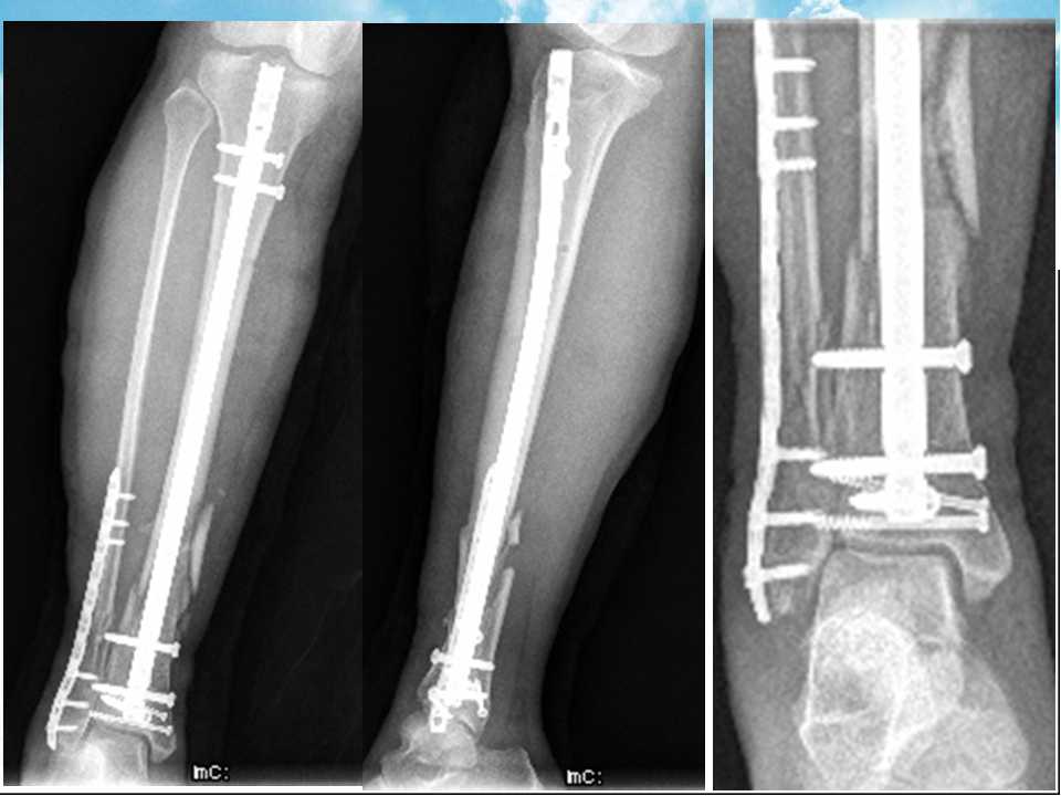 地震伤员胫骨远端骨折多是高能量损伤,开放性骨折伴严重软组织损伤或