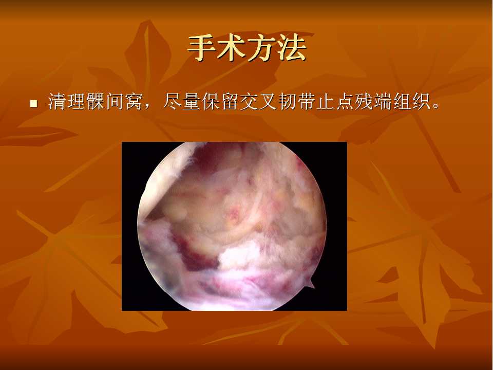 lars 人工韧带关节镜下一 期同时重建治疗前后交叉韧带联合损伤