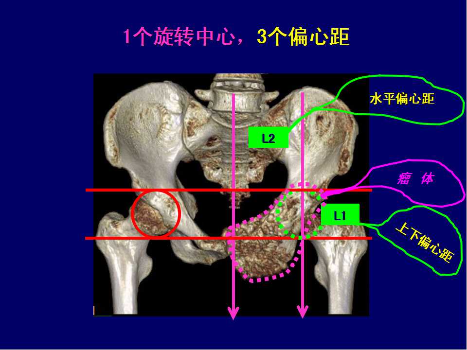 半骨盆髋关节旋转中心术中定位导航技术与常规方法效果评价