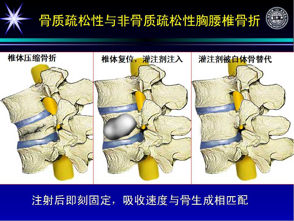 pkp pvp治疗胸腰椎骨折的思考