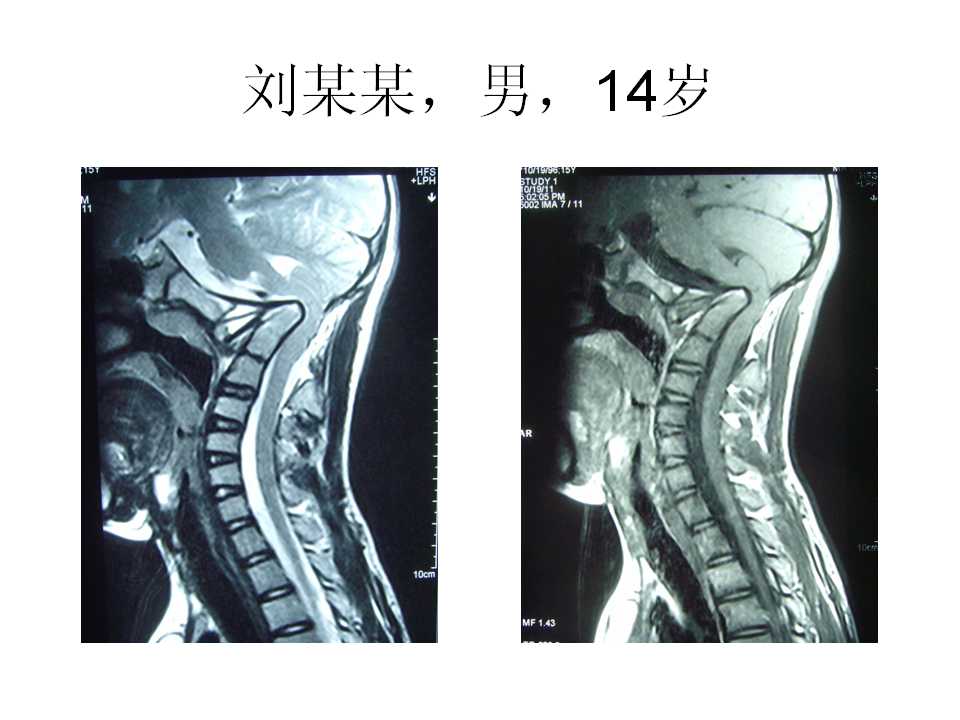 goel技术治疗寰枢椎脱位