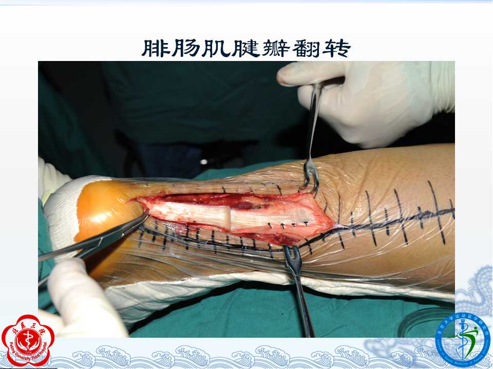 跟腱断裂术后并发症及其治疗