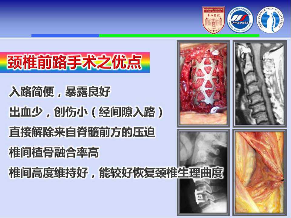 颈椎前路手术的入路解剖与临床应用