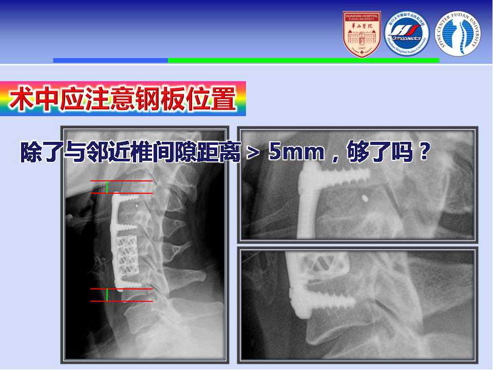 颈椎前路手术的入路解剖与临床应用