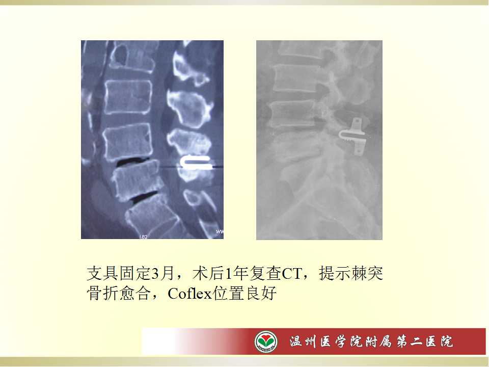 coflex腰椎棘突间动态稳定装置的临床应用评价—108例