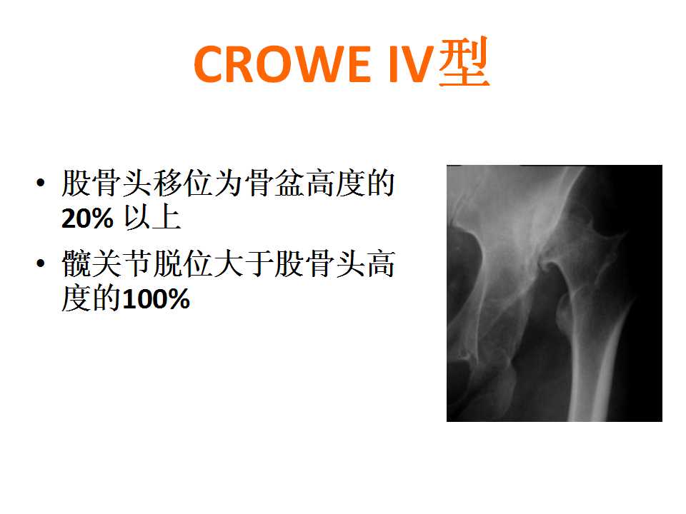 crowe iv 型ddh tha的肢体平衡