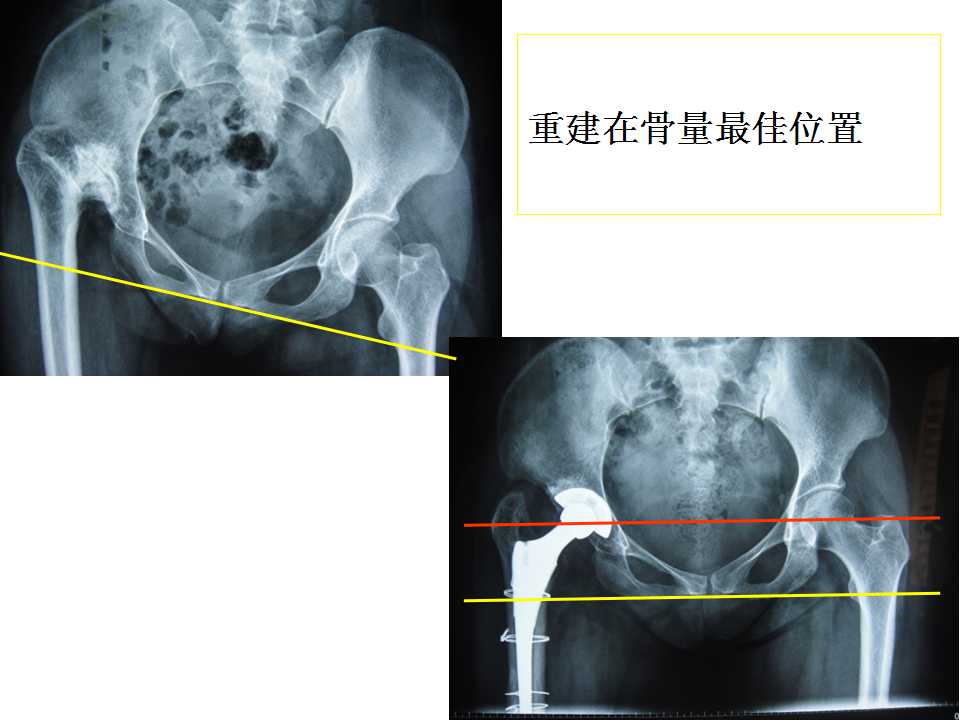 croweii/iii全髋置换的髋臼重建难点与处理