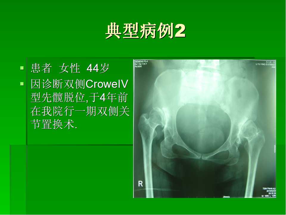 croweiv型成人髋脱位的全髋关节置换术
