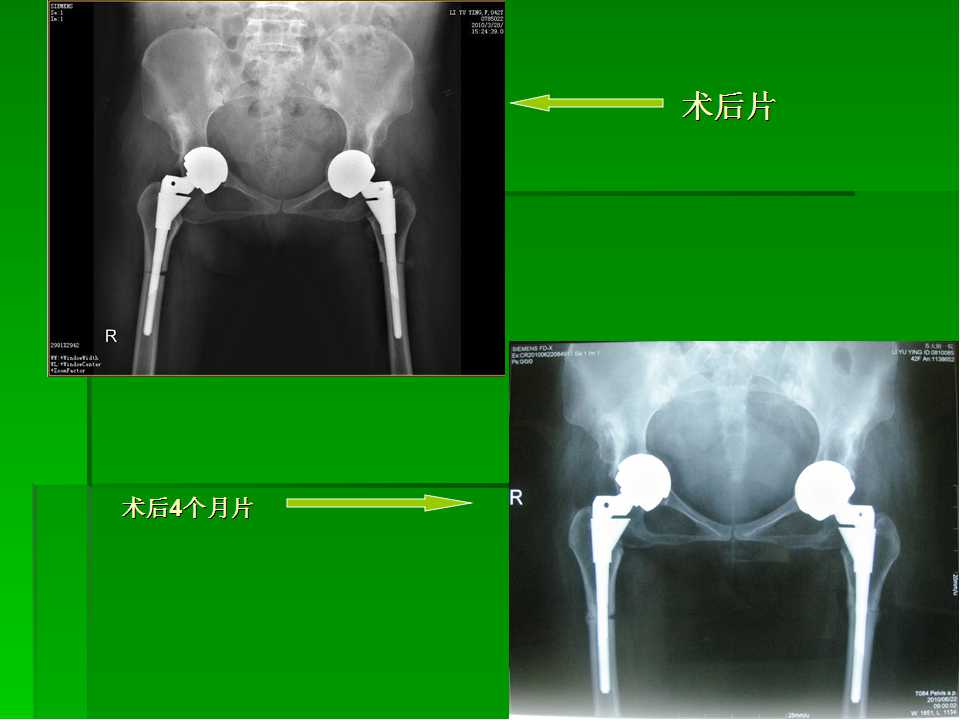 croweiv型成人髋脱位的全髋关节置换术