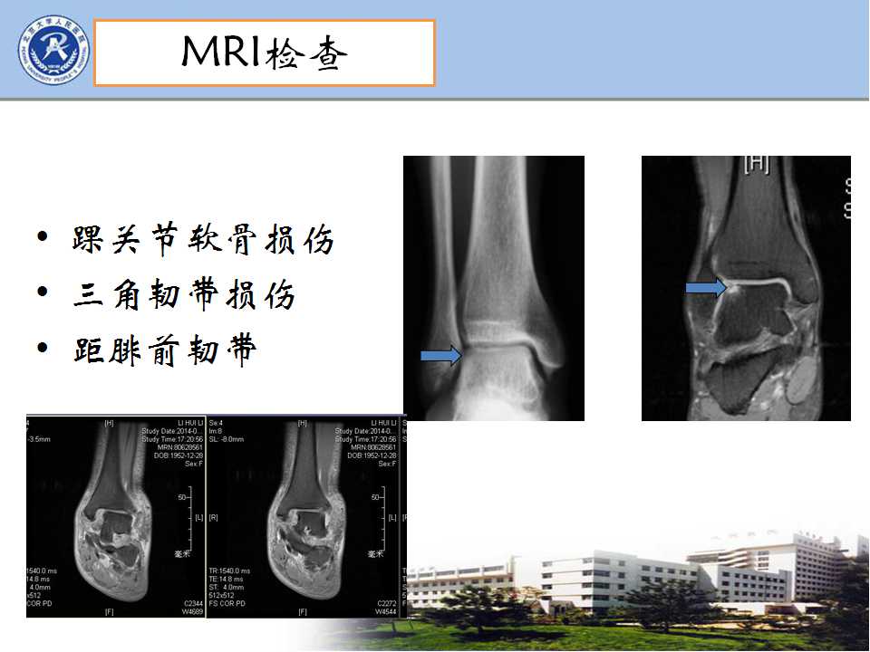 踝关节骨折的手术治疗策略