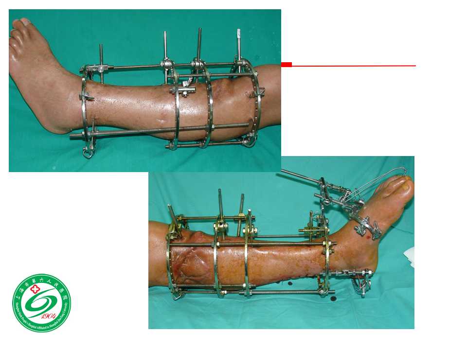 小腿软组织缺损的骨外固定治疗