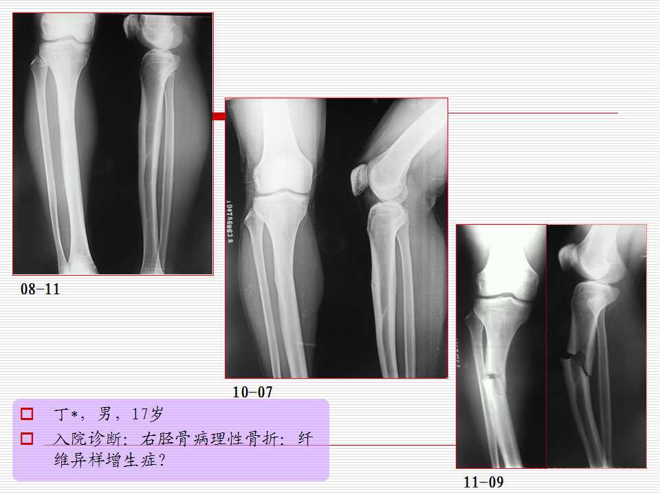 外固定支架在骨肿瘤保肢中的应用