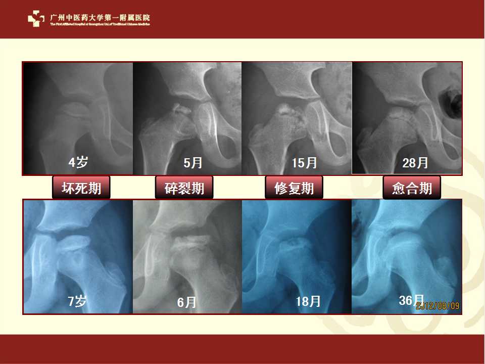 100例perthes病非手术临床疗效及相关预后因素分析