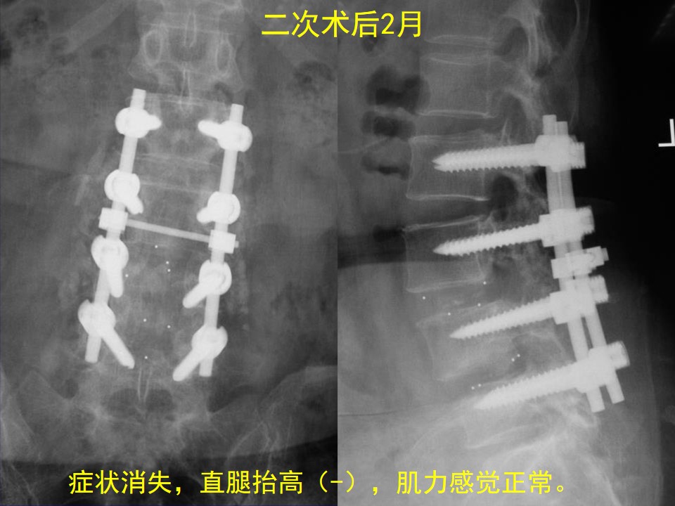 腰椎滑脱症手术并发症及临床防治策略