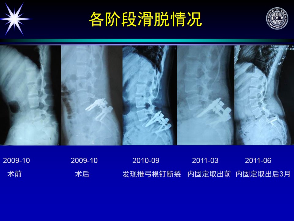 腰椎滑脱症手术并发症及临床防治策略