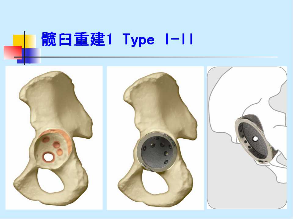 髋臼骨折内固定术后感染的全髋关节置换术