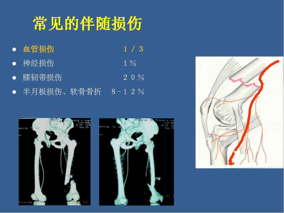 股骨远端骨折