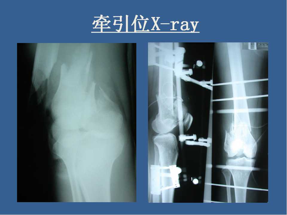 股骨远端骨折