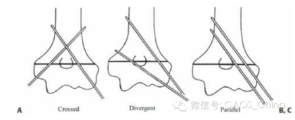 图2. 克氏针固定的三种方式:A:交叉克氏针;B:成角克氏针;C平行克氏针 Bloom等研究发现从外侧打入三枚成角克氏针的强度与内外各一枚交叉克氏针的强度相似,均强于外侧两枚平行克氏针的强度。Feng等研究发现外侧成角两枚和三枚克氏针的强度相当,且均强于内外交叉克氏针,内外交叉克氏针仅仅在外翻强度上优于外侧克氏针。因此,从目前的生物力学试验结果来看,支持外侧成角克氏针固定。 Skaggs等针对外侧进针的研究结果提示了外侧进针的技术要点: 1.