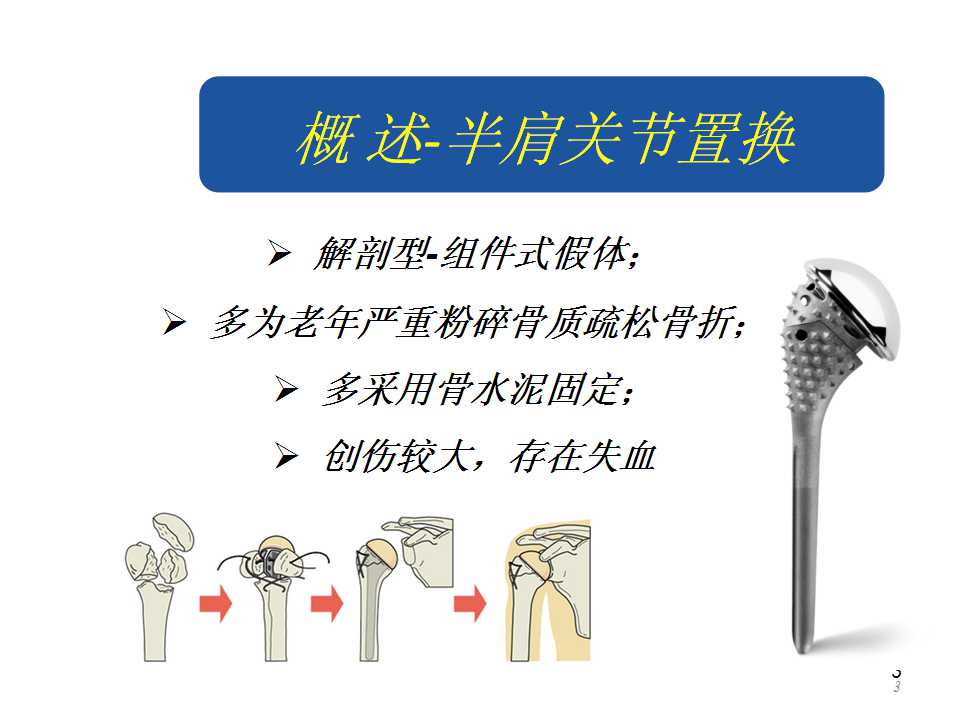 半肩关节置换患者的隐性失血分析