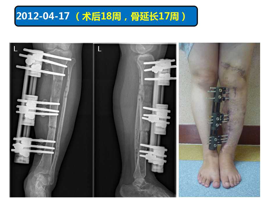 骨搬运技术在长骨感染性节段性骨缺损中的应