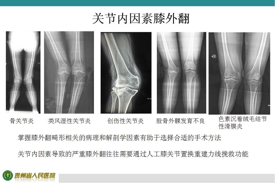 人工膝关节置换治疗严重膝外翻的策略