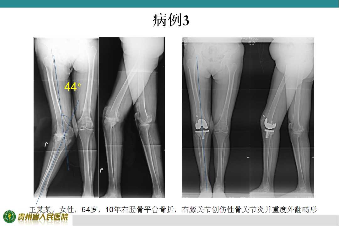 人工膝关节置换治疗严重膝外翻的策略