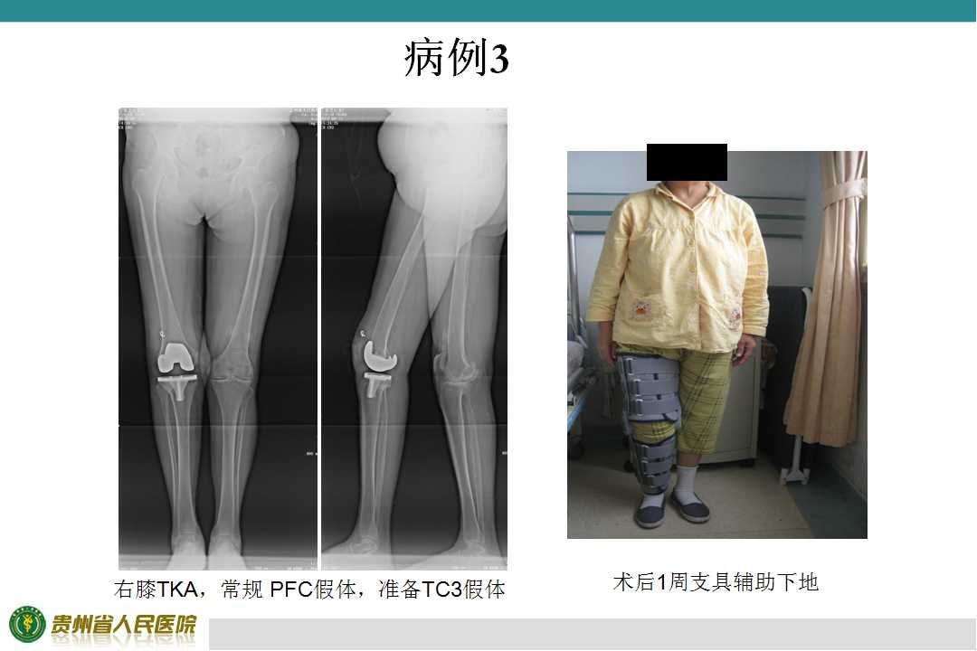 人工膝关节置换治疗严重膝外翻的策略