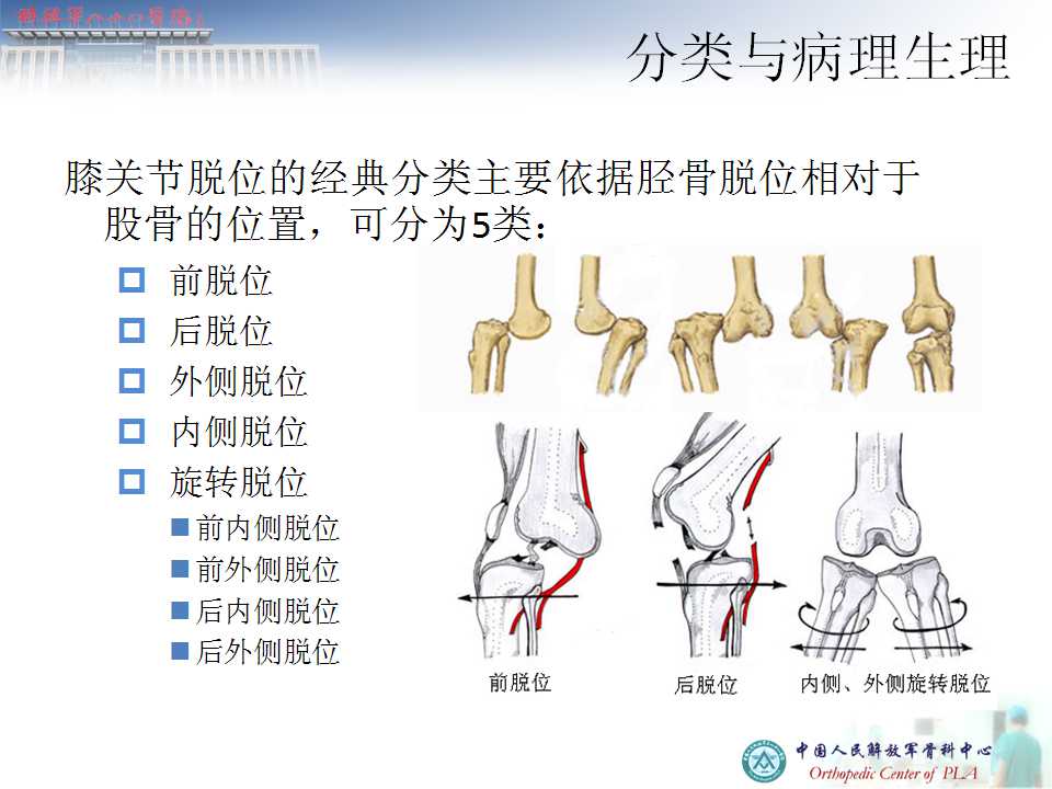 以往对此病认识不足,课件作者孙磊教授从膝关节脱位分类讲起,分析脱位