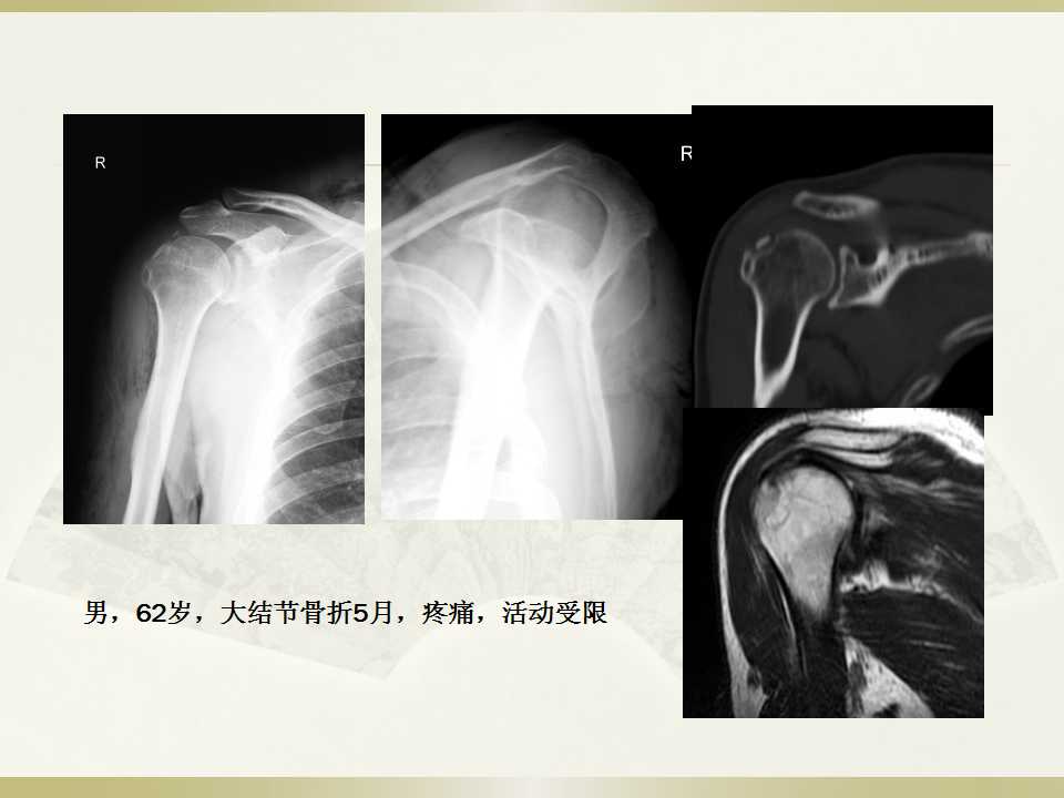 肩关节骨折脱位-重新认识