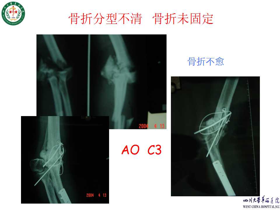 肱骨远端骨折手术内固定失效原因分析及对策