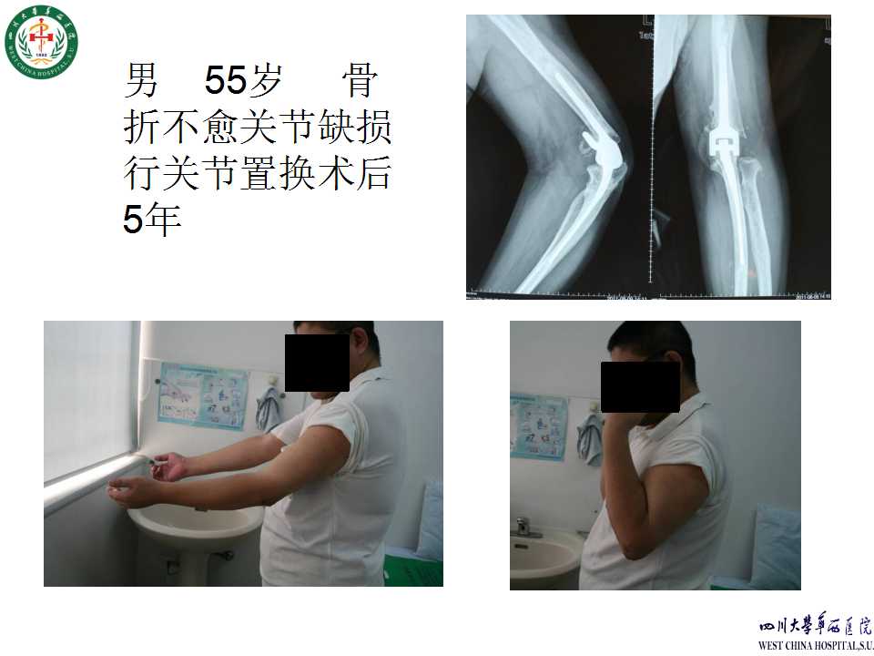 肱骨远端骨折手术内固定失效原因分析及对策