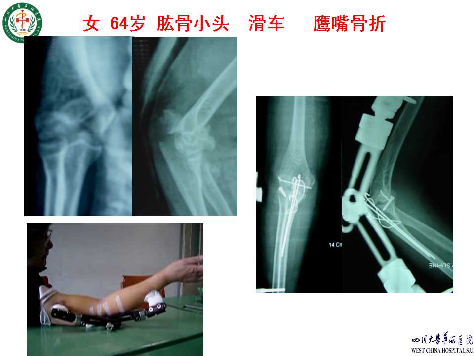 肱骨远端骨折手术内固定失效原因分析及对策