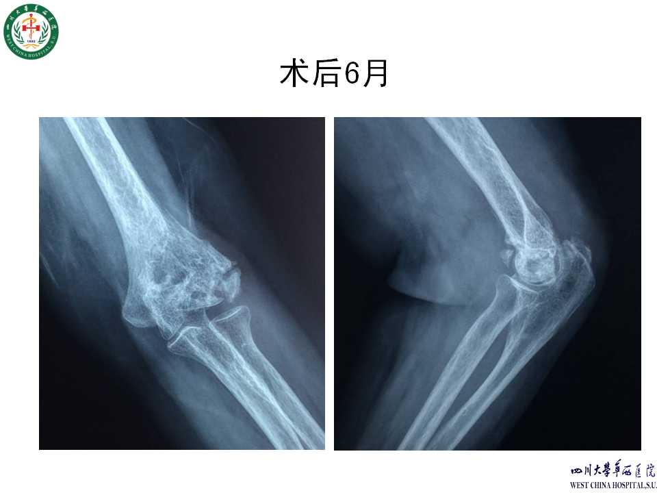 肱骨远端骨折手术内固定失效原因分析及对策