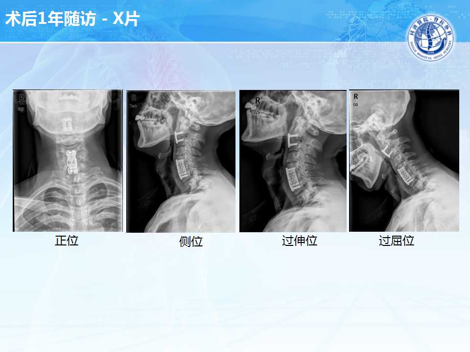 颈椎过伸伤的现代诊治策略与思考