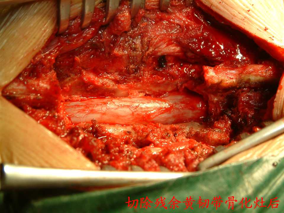脊柱术后常见并发症及处理