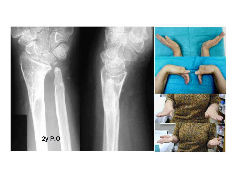 桡骨远端骨折治疗流程