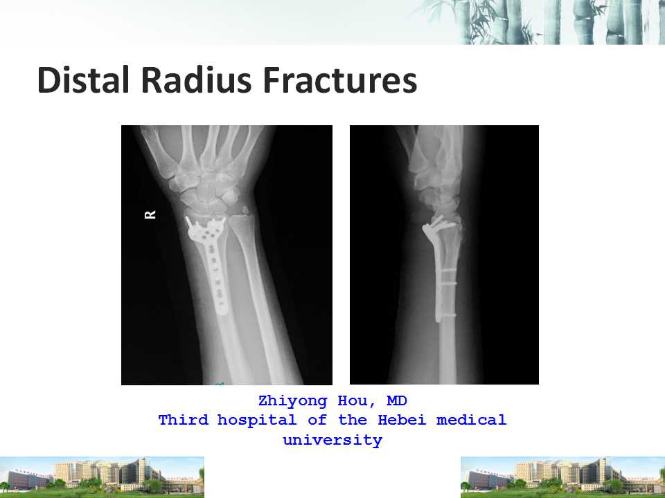 distal radius fractures