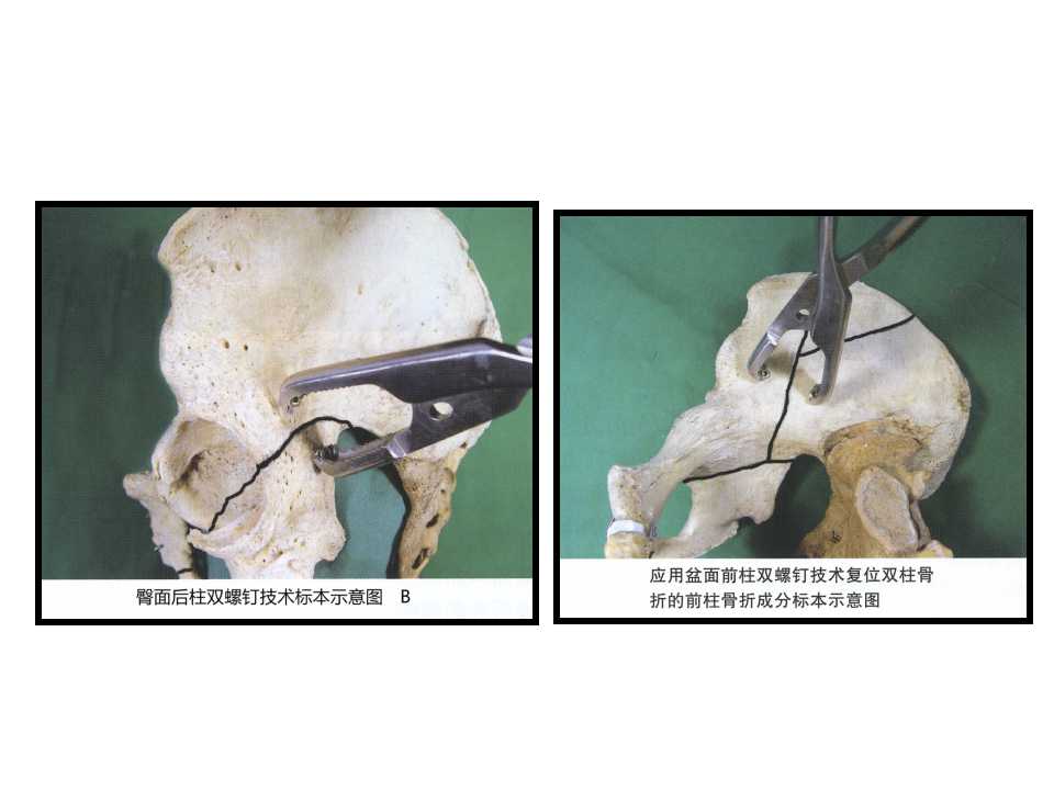 骨盆髋臼骨折手术中复位技巧