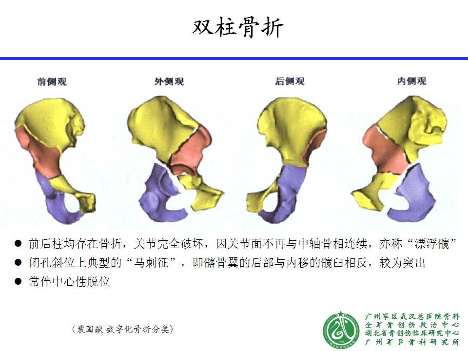 涉及髋臼方形区骨折的治疗经验分享---前路手术术前设计与体会