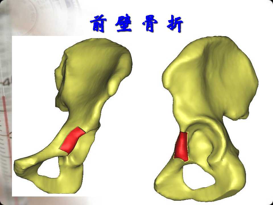髋臼骨折的分型及影像学诊断