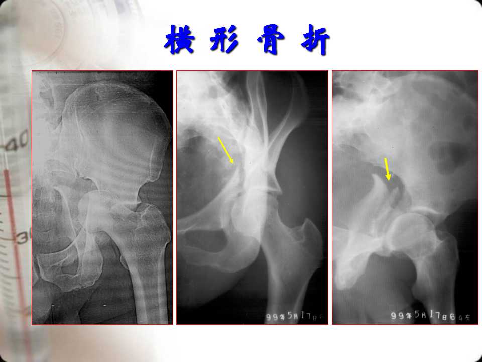 髋臼骨折的分型及影像学诊断
