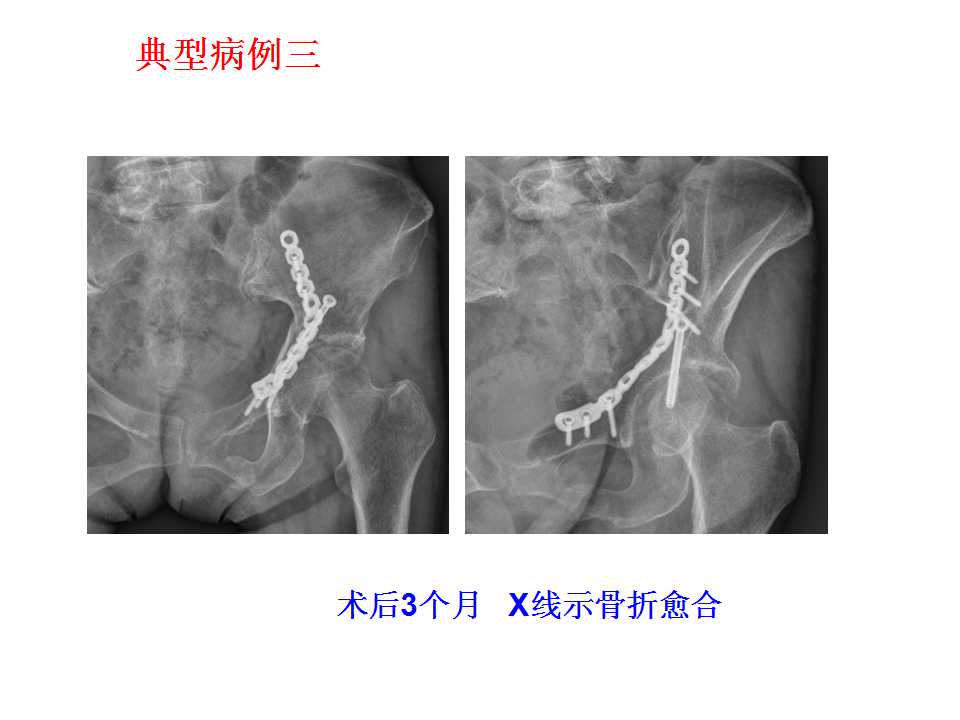 经腹直肌外侧切口入路在骨盆,髋臼骨折中的应用