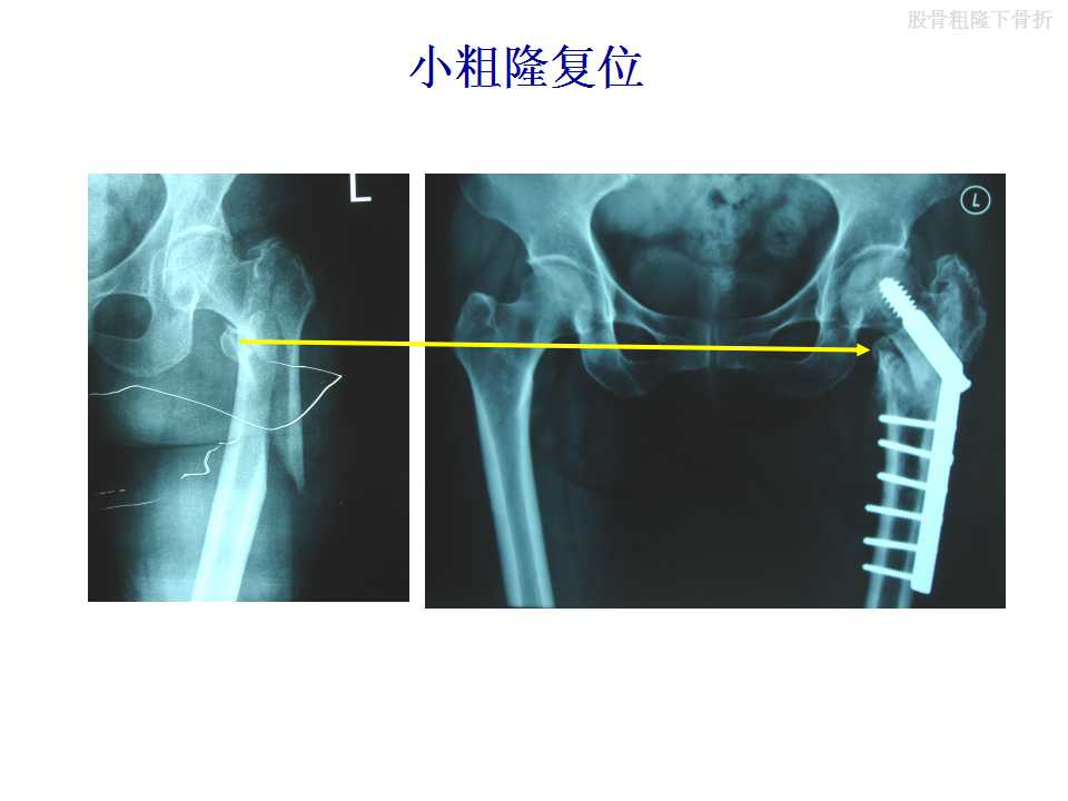 股骨粗隆下骨折