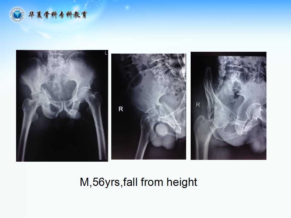 髋臼骨折手术治疗